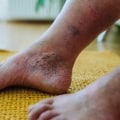 Understanding Diabetic Foot Problems