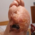 Understanding Diabetic Foot Ulcers: Early Signs and Prevention