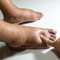 Expert Insights: Understanding the Symptoms of Diabetic Foot