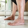 The Importance of Recognizing Red Flags for Diabetic Feet