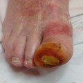 Preventing Amputations in Diabetic Feet