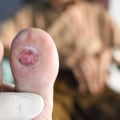 Understanding Stage 4 Diabetic Foot Ulcers