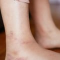 The Early Warning Signs of Diabetes in Your Feet