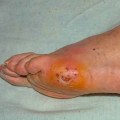 Expert Insights: Understanding Foot Problems in Diabetes