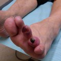 Diabetes and Toenail Health: What Do Diabetic Toenails Look Like and How to Care for Them