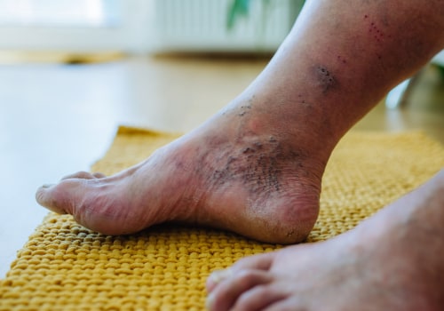 Understanding Diabetic Foot Problems