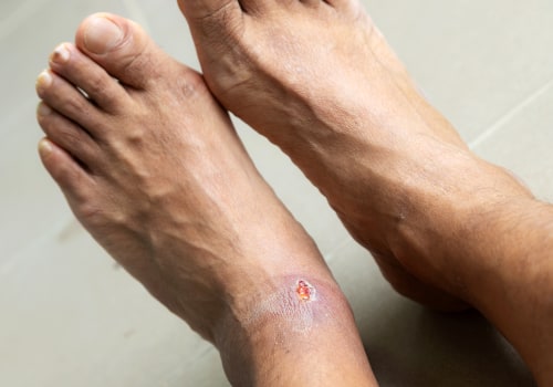 The 5 Stages of Diabetic Foot: Understanding the Progression of this Common Complication