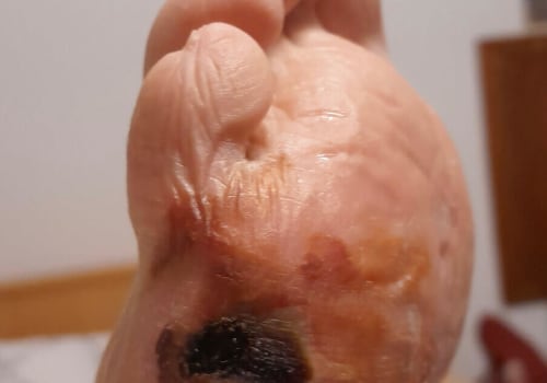 Understanding Diabetic Foot Ulcers: Early Signs and Prevention