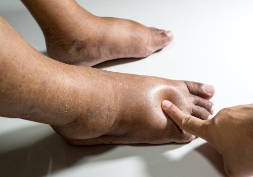 Expert Insights: Understanding the Symptoms of Diabetic Foot