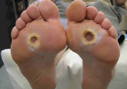 Understanding Diabetic Feet: What They Look Like and How to Care for Them