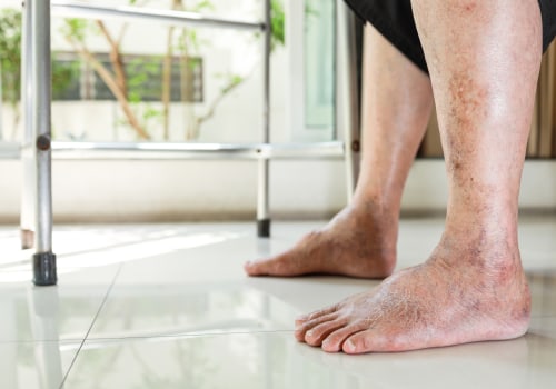 The Importance of Recognizing Red Flags for Diabetic Feet