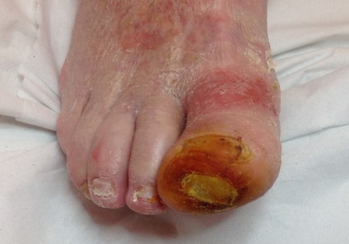 Preventing Amputations in Diabetic Feet