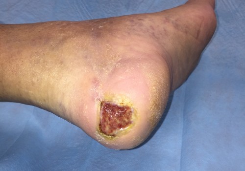 Understanding the Last Stage of Diabetic Foot