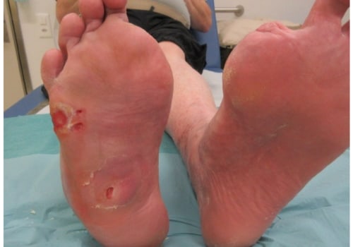 Can Diabetic Foot Be Cured? My Expert Perspective