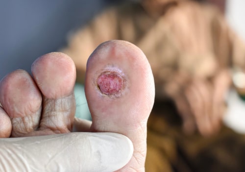 Understanding Stage 4 Diabetic Foot Ulcers