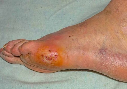 Expert Insights: Understanding Foot Problems in Diabetes