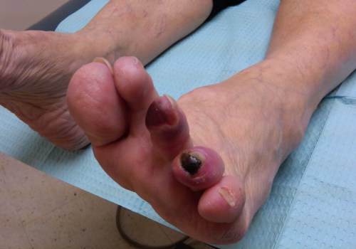 Diabetes and Toenail Health: What Do Diabetic Toenails Look Like and How to Care for Them